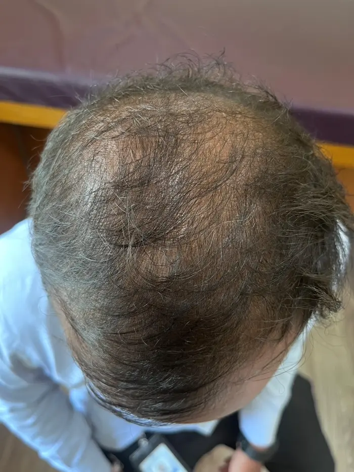 Male Pattern Baldness case 3 before treatment